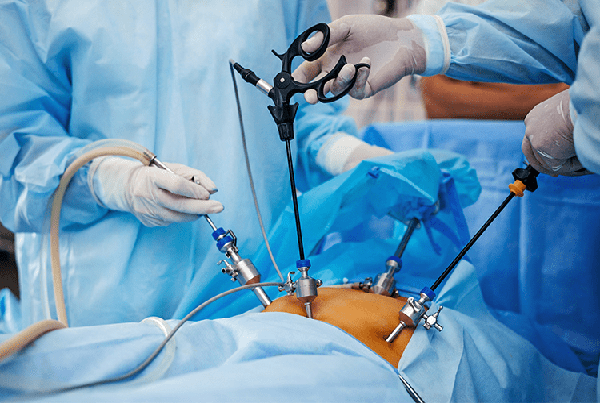Laparoscopic Cholecystectomy