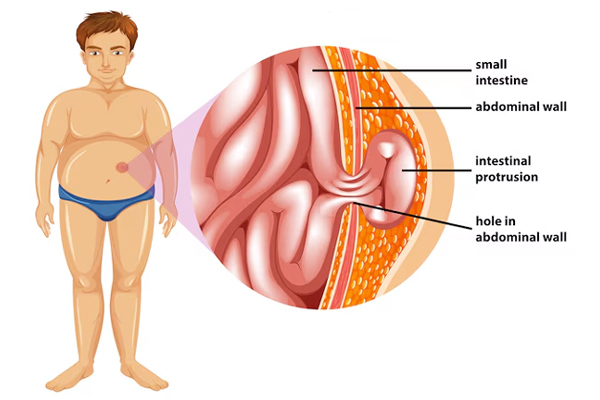 Complex and Recurrent Hernia Surgery