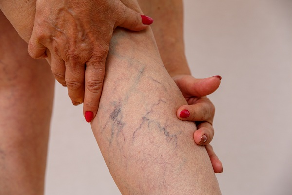 Varicose Veins  Laser Treatment