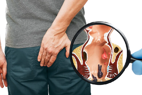 Haemorrhoid Surgery Laser and Minimally Invasive