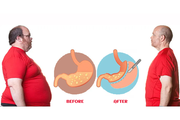 Bariatric Surgery